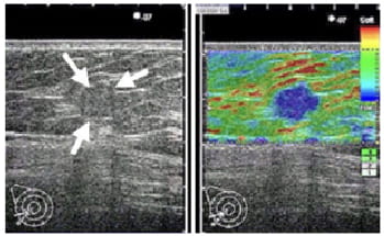 乳房超音波検診画像